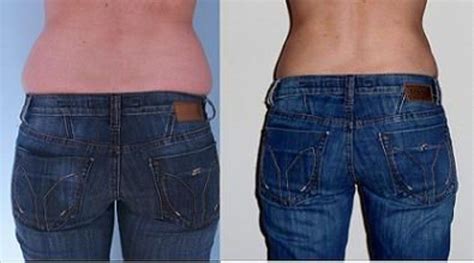 porovnávacia fotografia brucha pred a po liposukcii