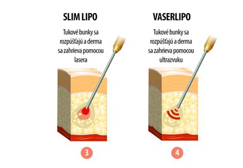 Schéma zobrazujúca postup laserovej liposukcie: zavedenie vlákna, rozpúšťanie tuku, odsatie