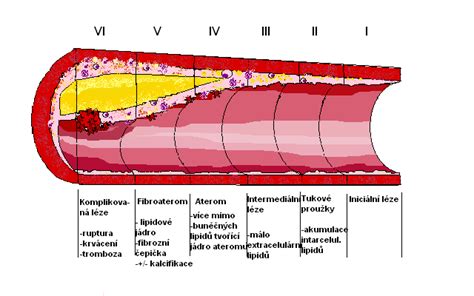 Schéma vývoja aterosklerotického plátu v cievnej stene