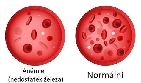 Infografika zobrazujúca bežné príznaky nedostatku železa.